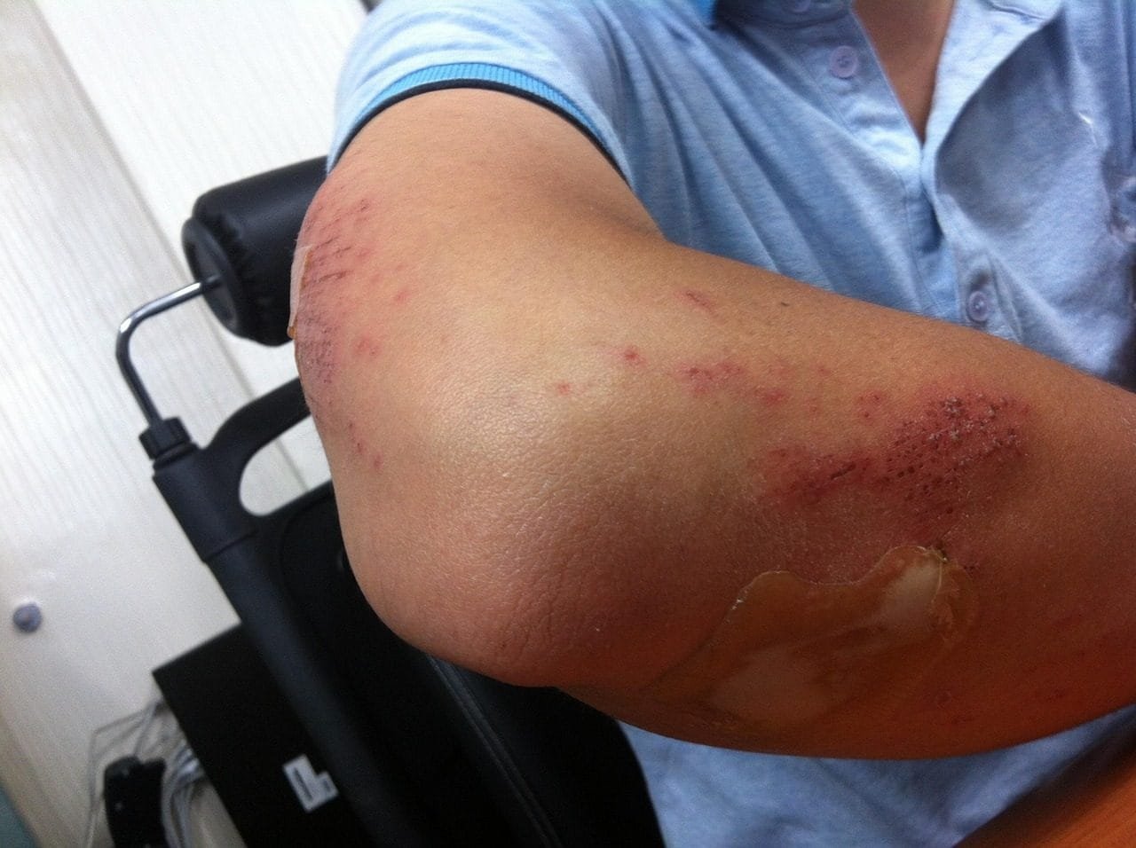 injury, arm, injured, hurt, man, elbow, pain, bandage, treatment, medical, health, acciden